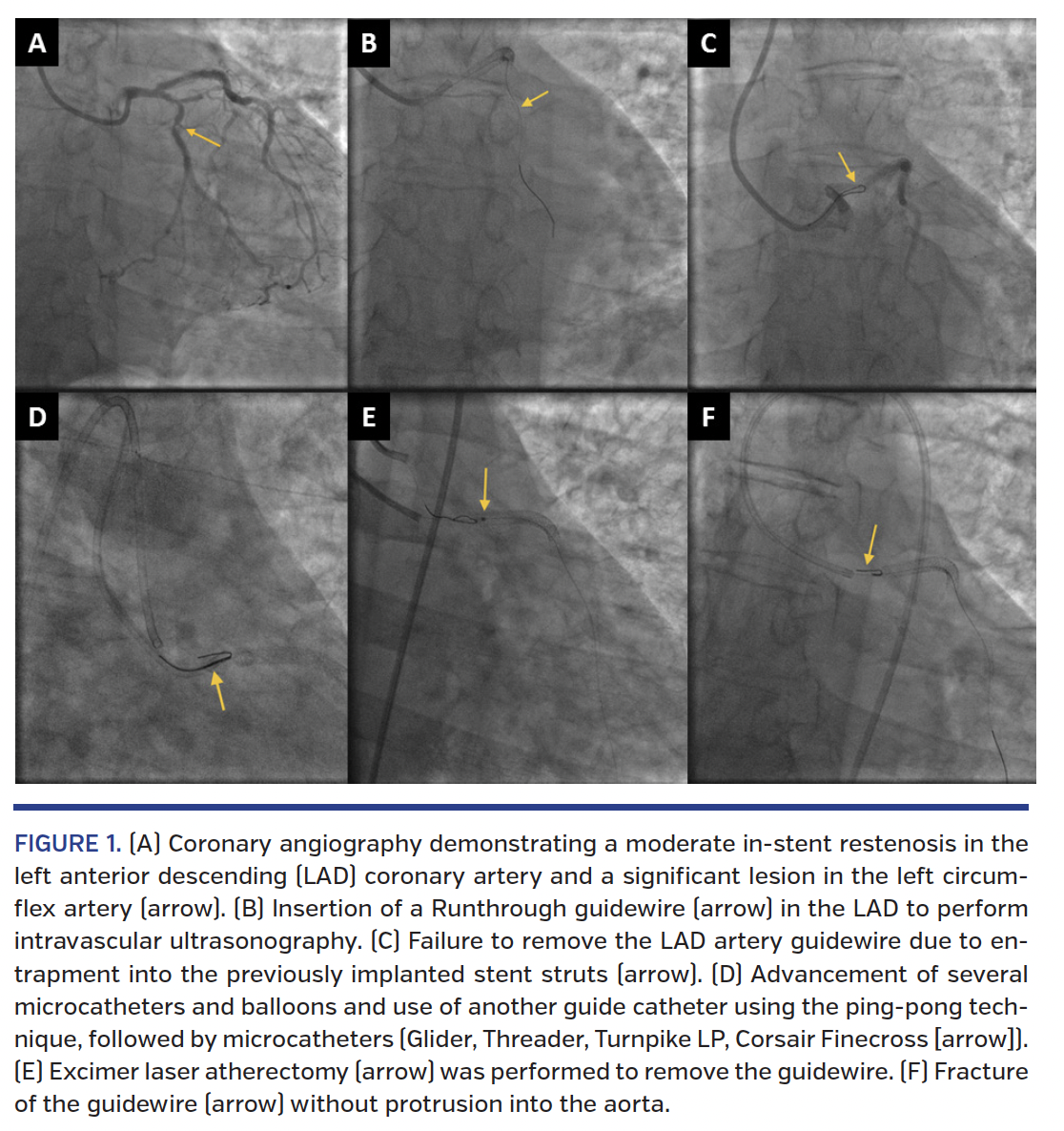 Management of Guidewire Entrapment With Laser Atherectomy